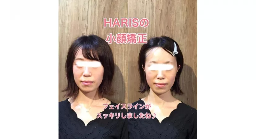 フェイスラインがすっきりして小顔効果も／大阪の心斎橋で人気の美容鍼灸サロンHARIS