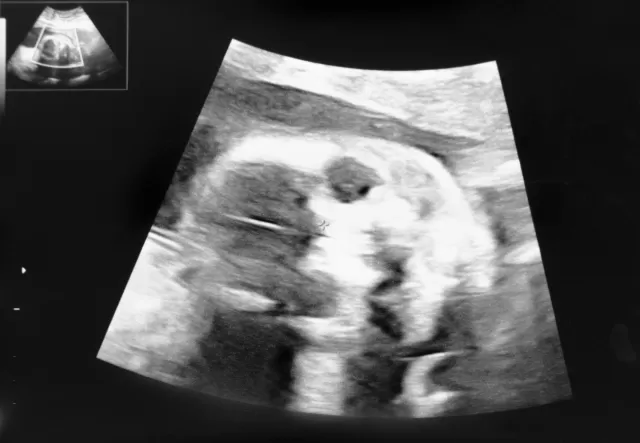 妊娠して21週目の胎児のエコー写真
