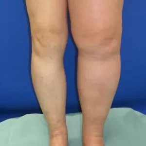リンパ浮腫　