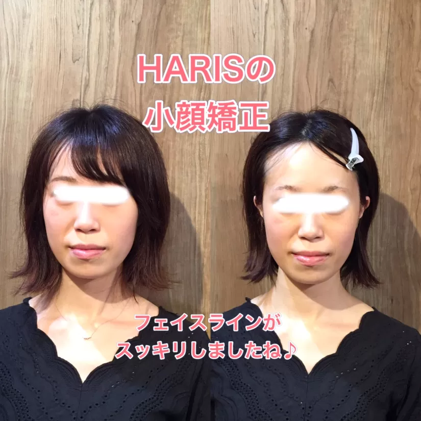 小顔矯正を受けた女性2