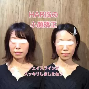 フェイスラインがすっきりして小顔効果も／大阪の心斎橋で人気の美容鍼灸サロンHARISのサムネイル