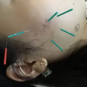 ニキビ、ニキビ跡の改善には美容鍼が効果的ですのサムネイル