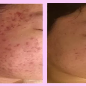 花粉による皮膚炎が増えています。鍼治療が有効です。のサムネイル